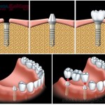 Cấy ghép implant - kỹ thuật trồng răng hiệu quả