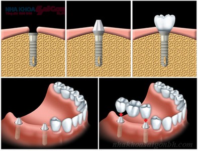 Cấy ghép implant - kỹ thuật trồng răng hiệu quả