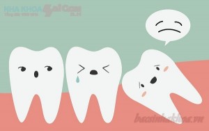 Răng khôn mọc lệch có thể gây ra chứng đau nửa đầu