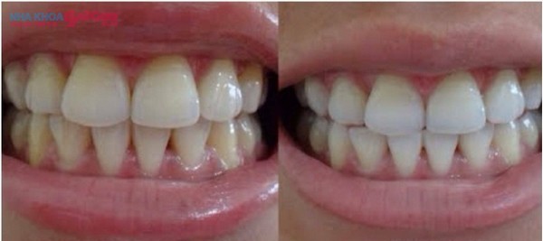 kết quả sau khi sử dụng miếng dán làm trắng răng
