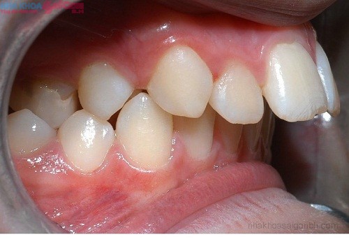 Khi bị hô do xương hàm có niềng răng được không?