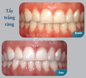 Trước và sau khi tẩy trắng răng với công nghệ Brite Smile