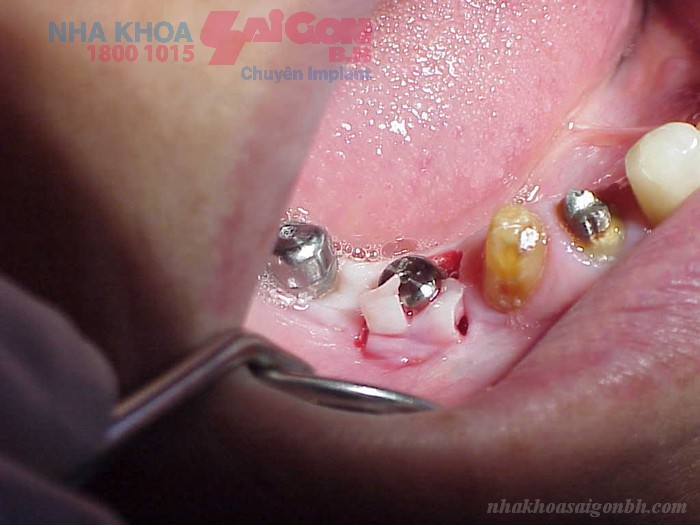 Vệ sinh răng trước khi cấy ghép implant quan trọng không?