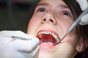 Cần lưu ý những gì khi chỉnh nha niềng răng thẩm mỹ?