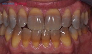 răng bị nhiễm tetra có tẩy trắng được không?