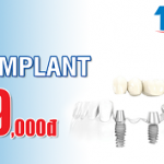 Trồng răng implant với giá cực kỳ ưu đãi 9,999,000đ