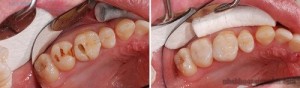 Bọc răng sứ cho răng sâu