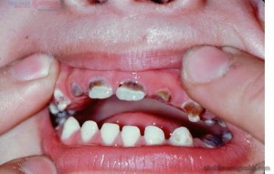 Sâu răng sữa ở trẻ