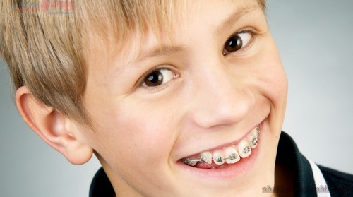 Chỉnh nha niềng răng sớm có lợi ích gì?
